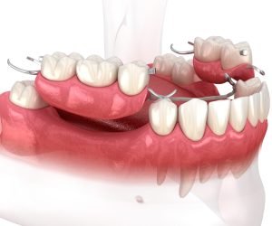 removable partial denture