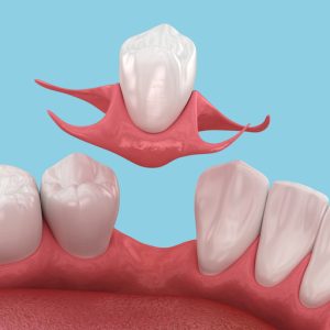 removable dental flipper